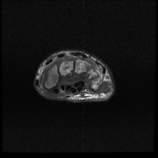 File:Avascular necrosis - scaphoid non-union (Radiopaedia 63457-72065 Axial T1 9).jpg