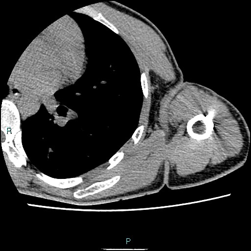 File:Avascular necrosis after fracture dislocations of the proximal humerus (Radiopaedia 88078-104653 D 78).jpg