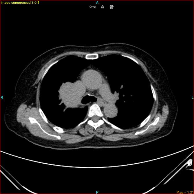 Azygos vein aneurysm (Radiopaedia 77824-90130 A 24).jpg