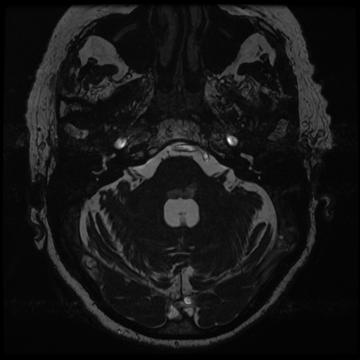 File:Balo concentric sclerosis (Radiopaedia 53875-59982 Axial T2 FIESTA 30).jpg