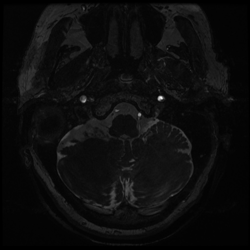 File:Balo concentric sclerosis (Radiopaedia 53875-59982 Axial T2 FIESTA 7).jpg