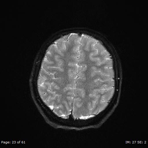 File:Balo concentric sclerosis (Radiopaedia 61637-69636 Axial DWI 23).jpg