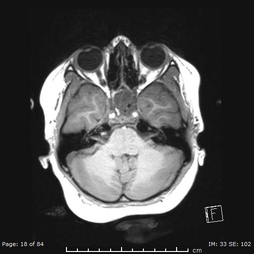 File:Balo concentric sclerosis (Radiopaedia 61637-69636 Axial T1 18).jpg