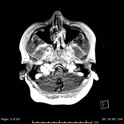 File:Balo concentric sclerosis (Radiopaedia 61637-69636 Axial T1 C+ 3).jpg