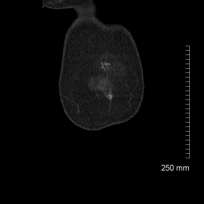 Bariatric intragastric ballon (Radiopaedia 62114-70216 B 4).jpg