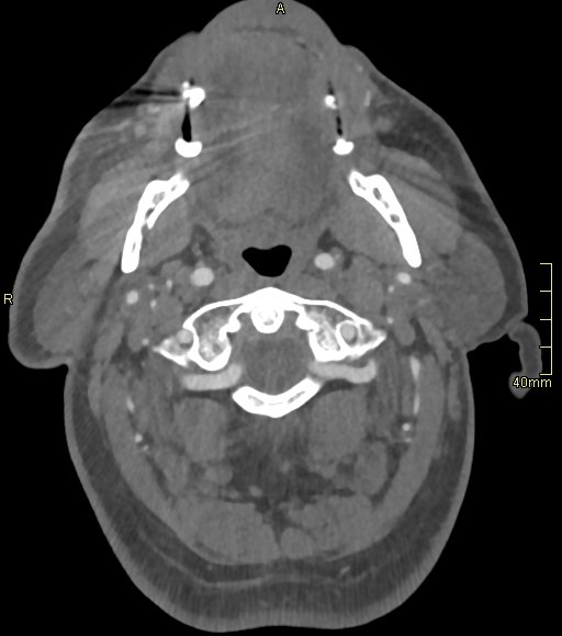 Basilar artery aneurysm (Radiopaedia 56261-62932 A 27).jpg