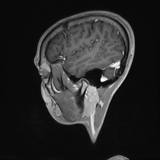 Basilar artery perforator aneurysm (Radiopaedia 82455-97733 G 29).jpg