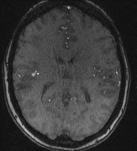 File:Basilar tip aneurysm (Radiopaedia 26504-26632 MRA 146).jpg