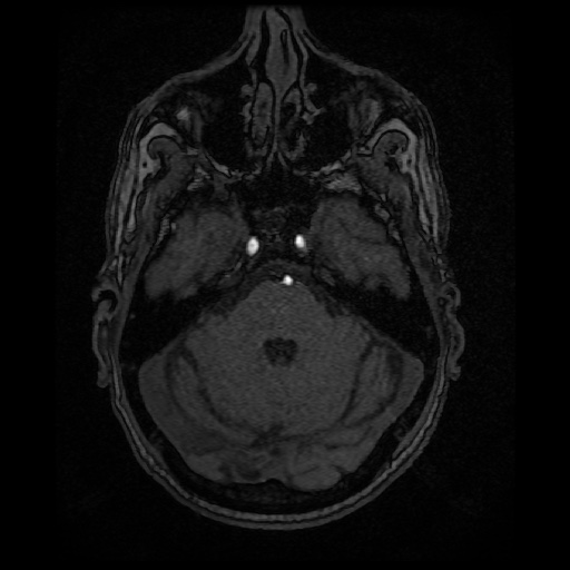 Basilar top and left middle cerebral artery aneurysm (Radiopaedia 61965-70031 Axial MRA 38).jpg