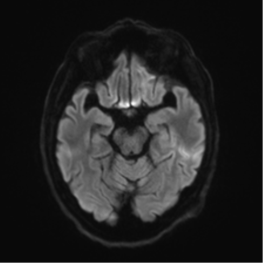 File:Behavioral variant frontotemporal dementia and late onset schizophrenia (Radiopaedia 52197-58083 Axial DTI Trace W 37).png