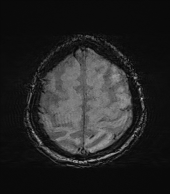 File:Behavioral variant frontotemporal dementia and late onset schizophrenia (Radiopaedia 52197-58083 Axial SWI 64).png