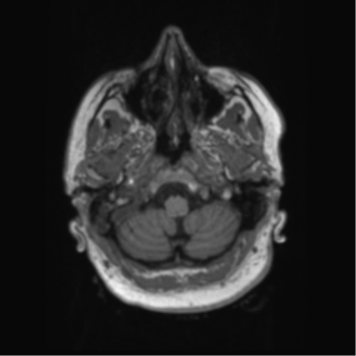 Behavioral variant frontotemporal dementia and late onset schizophrenia (Radiopaedia 52197-58083 Axial T1 99).png