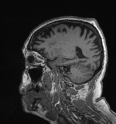File:Behavioral variant frontotemporal dementia and late onset schizophrenia (Radiopaedia 52197-58083 Sagittal T1 71).png