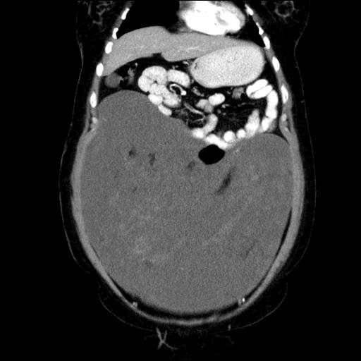 File:Benign spindle cell tumor - abdominopelvic (Radiopaedia 61300-69212 C 18).jpg