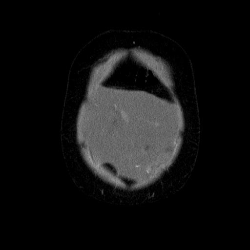 File:Benign spindle cell tumor - abdominopelvic (Radiopaedia 61300-69212 C 8).jpg