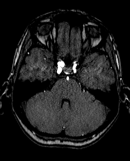 Berry aneurysm of the terminal internal carotid artery (Radiopaedia 88286-104918 Axial TOF 85).jpg
