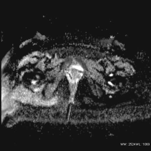 File:Bicornuate uterus- on MRI (Radiopaedia 49206-54297 Axial ADC 21).jpg