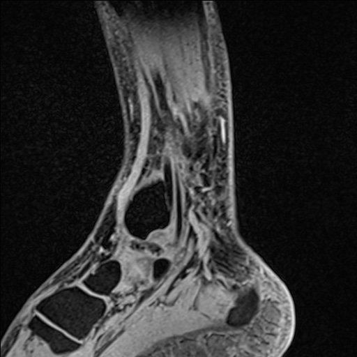 Bilateral Achilles tendon complete tear (Radiopaedia 81344-95051 Sagittal WE - Left 36).jpg