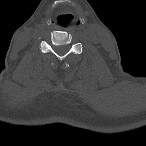 File:Bilateral C6-7 locked facet dislocation (Radiopaedia 28506-28748 Axial bone window 12).jpeg