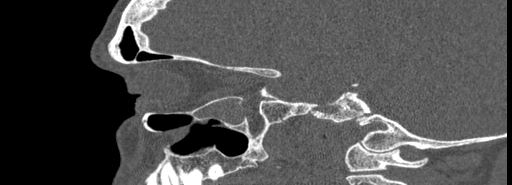 Bilateral Ectopic Infraorbital Nerves (Radiopaedia 49006-54084 Sagittal bone window 16).jpg