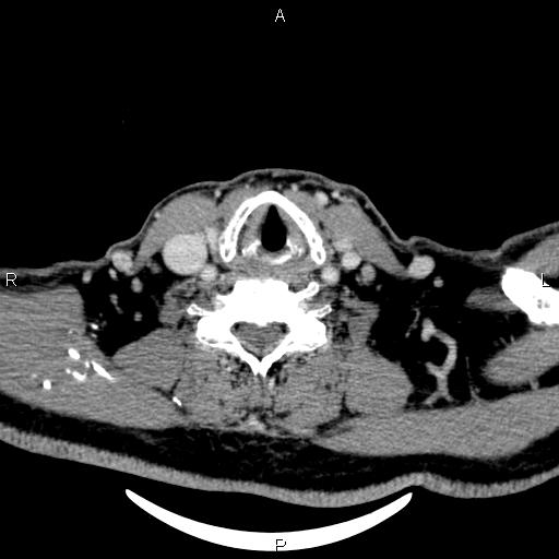 Bilateral Warthin tumors (Radiopaedia 84034-99263 Axial With contrast 48).jpg