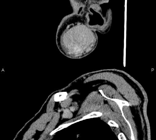 Bilateral Warthin tumors (Radiopaedia 84034-99263 D 70).jpg