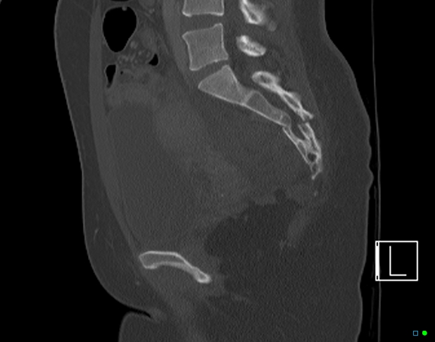 File:Bilateral acetabular fractures (Radiopaedia 79272-92308 Sagittal bone window 50).jpg