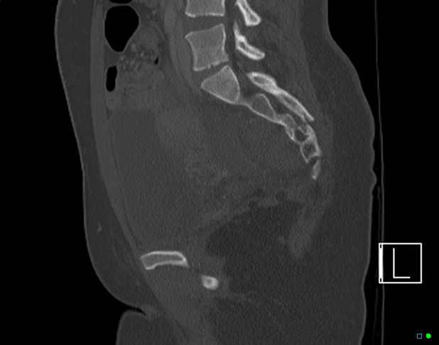 Bilateral acetabular fractures (Radiopaedia 79272-92308 Sagittal bone window 51).jpg