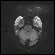 File:Bilateral acute middle cerebral artery territory infarcts (Radiopaedia 77319-89402 Axial DWI 32).jpg
