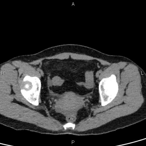 File:Bilateral adrenal gland hyperenhancement in pancreatitis (Radiopaedia 86642-102753 Axial non-contrast 100).jpg