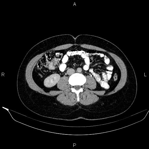 Bilateral adrenal myelolipoma (Radiopaedia 63058-71535 Axial C+ delayed 80).jpg