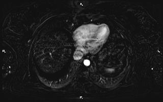 Bilateral adrenal myelolipoma (Radiopaedia 63058-71537 I 12).jpg