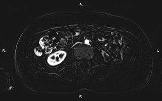 Bilateral adrenal myelolipoma (Radiopaedia 63058-71537 I 63).jpg