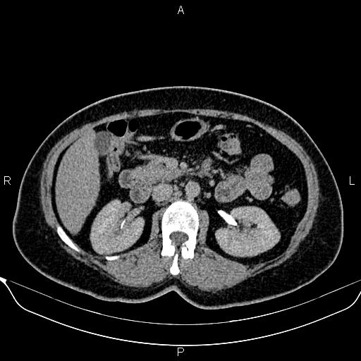 Bilateral benign adrenal adenomas (Radiopaedia 86912-103124 Axial C+ delayed 57).jpg