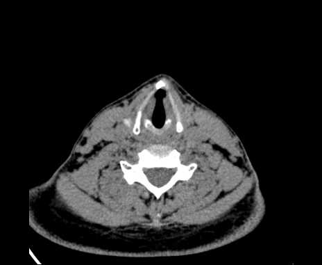 Bilateral carotid body tumors (Radiopaedia 61841-69870 Axial non-contrast 75).jpg