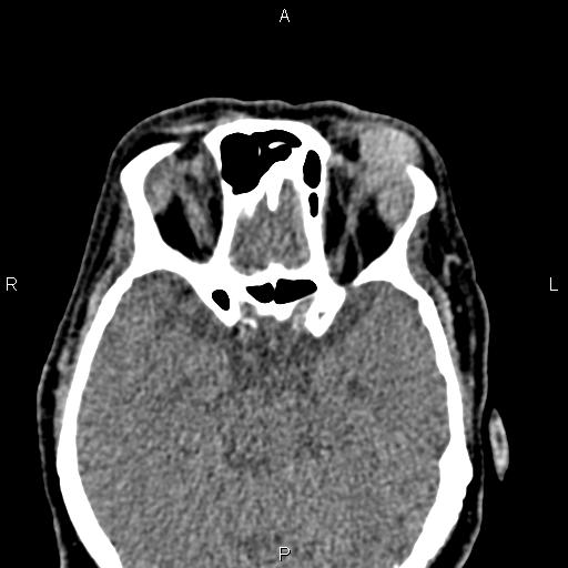 Bilateral enlargement of lacrimal glands - sarcoidosis (Radiopaedia 62627-70921 Axial non-contrast 57).jpg