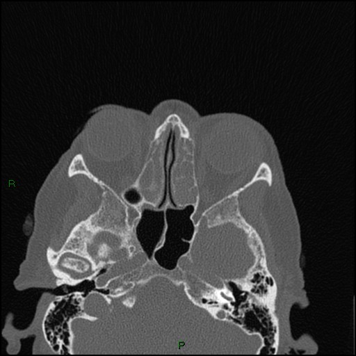 Bilateral frontal mucoceles (Radiopaedia 82352-96454 Axial bone window 152).jpg