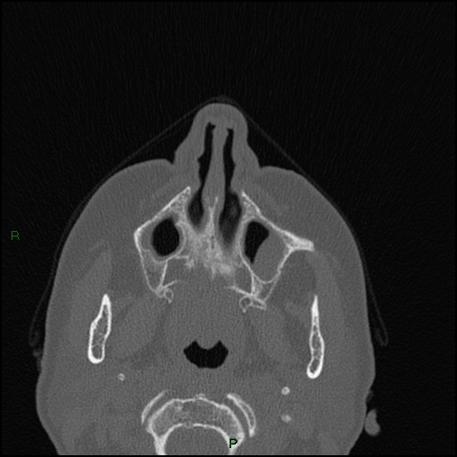 Bilateral frontal mucoceles (Radiopaedia 82352-96454 Axial bone window 224).jpg