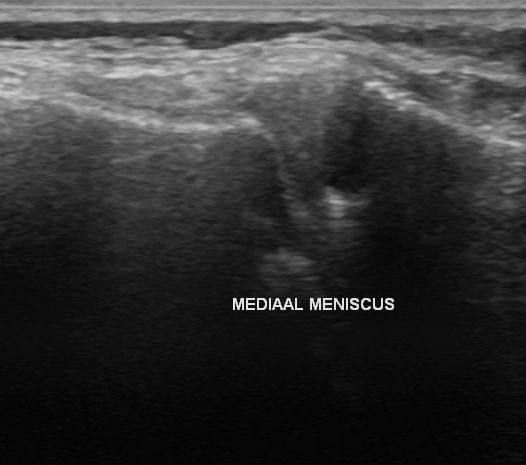File:Bilateral lateral meniscal cysts (Radiopaedia 12200-12525 Longitudinal 3).jpg