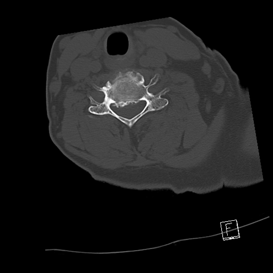 Bilateral occipital condyle fractures (type 3) (Radiopaedia 87672-104086 Axial bone window 54).jpg