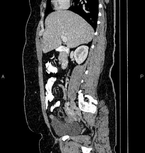 File:Bilateral ovarian dermoid cysts (Radiopaedia 85785-101603 D 32).jpg