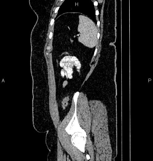 Bilateral ovarian dermoid cysts (Radiopaedia 85785-101603 D 82).jpg