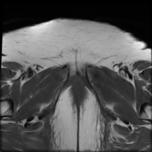 File:Bilateral ovarian dermoid cysts (Radiopaedia 90152-107338 Axial T1 24).jpg