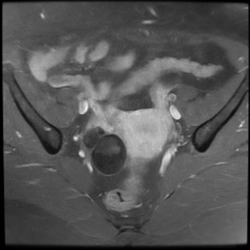 File:Bilateral ovarian dermoid cysts (Radiopaedia 90152-107338 Axial T1 C+ fat sat 9).jpg