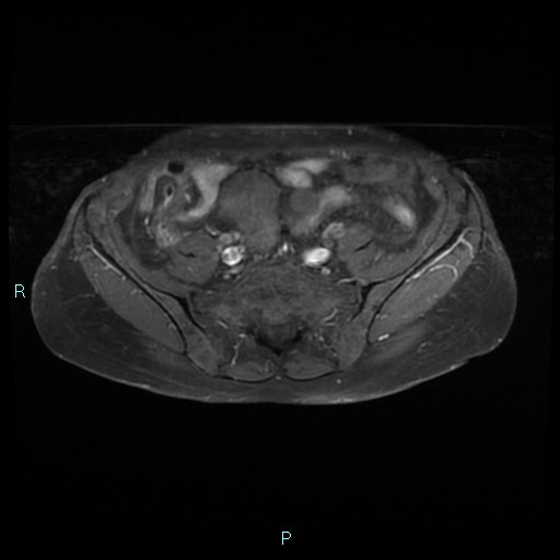 File:Bilateral ovarian fibroma (Radiopaedia 44568-48293 Axial T1 C+ fat sat 5).jpg