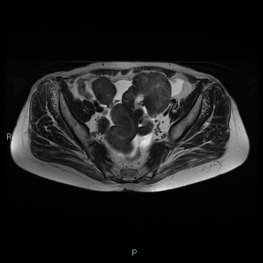 File:Bilateral ovarian fibroma (Radiopaedia 44568-48293 Axial T2 12).jpg