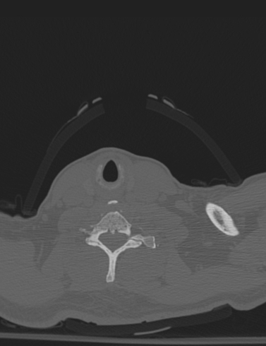 Bilateral perched facet joint (Radiopaedia 63149-71669 Axial bone window 52).jpg