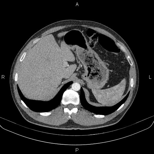 Bilateral pulmonary AVM (Radiopaedia 83134-97505 A 70).jpg
