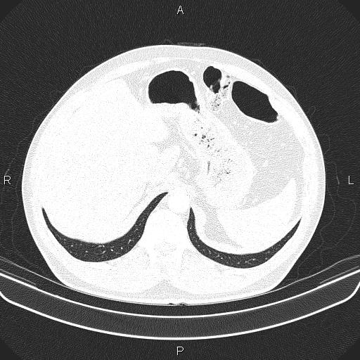 File:Bilateral pulmonary AVM (Radiopaedia 83134-97505 Axial lung window 71).jpg