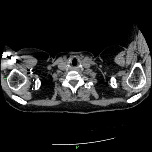 Bilateral pulmonary emboli (Radiopaedia 32700-33669 Axial C+ CTPA 1).jpg